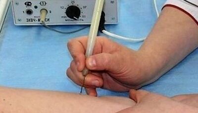 Cómo deshacerse de los papilomas en el cuerpo