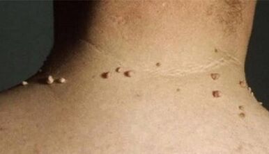Las razones de la aparición de papilomas en el cuerpo humano