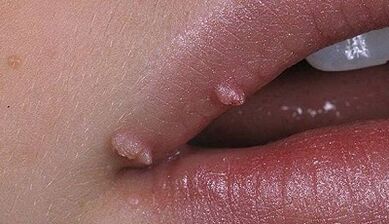 Tipos de papiloma en humanos