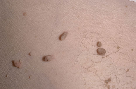 Papiloma