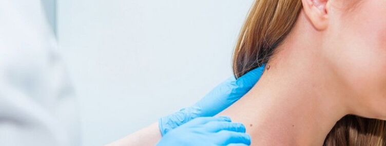 Papiloma en el cuello
