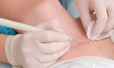 Métodos de eliminación de papilomas en el cuello