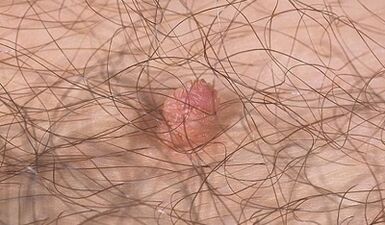 formas de transferir el virus del papiloma humano