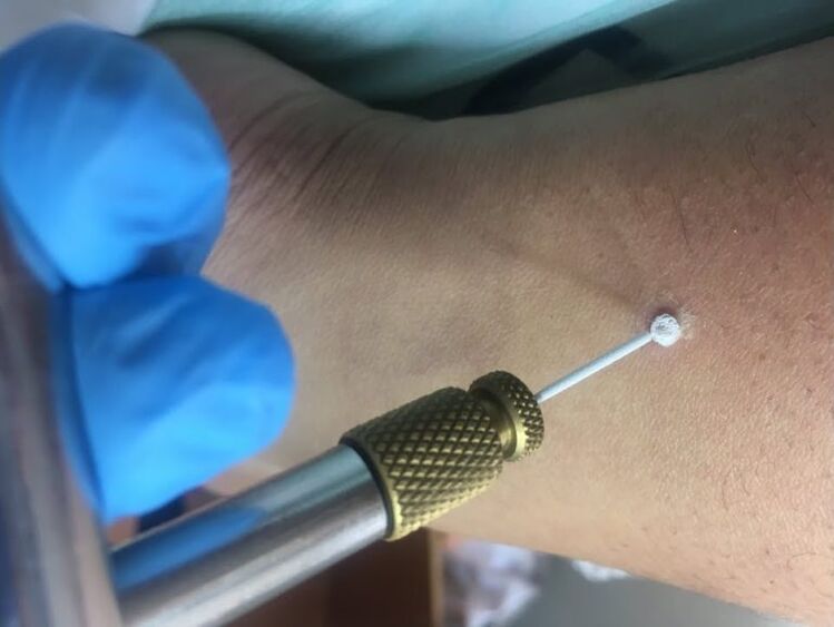 formas de eliminar las verrugas