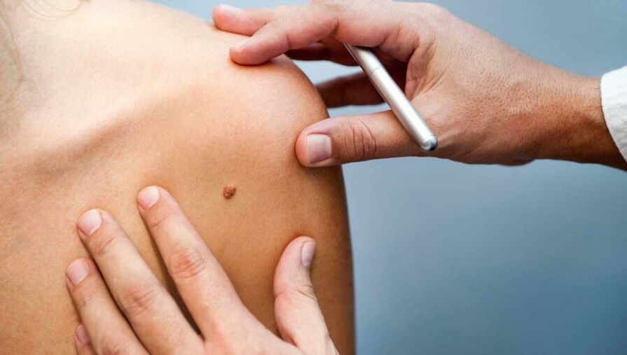 Dermatólogo examinando a un paciente con papiloma