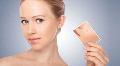 revisión de remedios efectivos para verrugas y papilomas