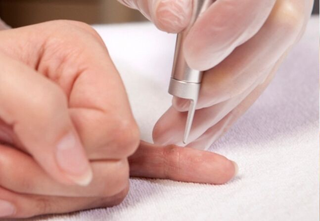 eliminación de verrugas en el dedo