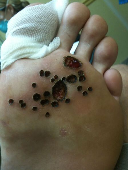Piel después de la extracción láser de verrugas en la pierna