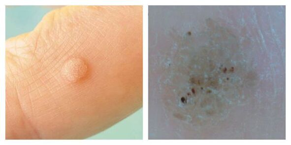 Verruga ordinaria durante el examen y la dermatoscopia