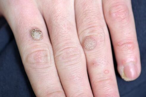 Warts en el brazo