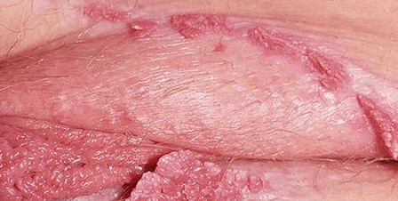 Candiloma