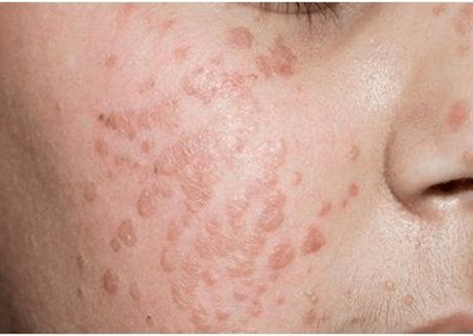 Warts de la juventud