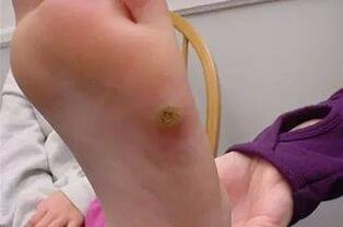 Warts en las manos
