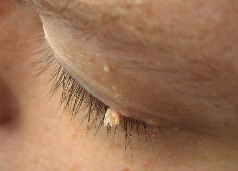 Warts frente a nuestros ojos