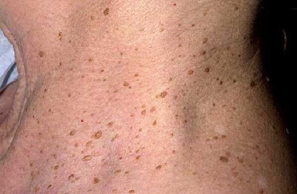 verrugas seniles