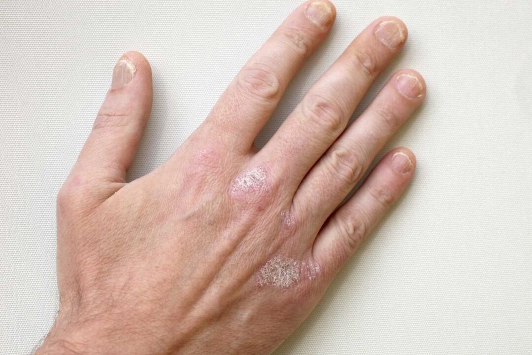 psoriasis en las manos de un hombre tratado con crema Keramin